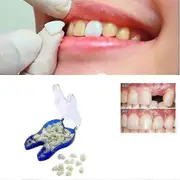 Temporary Tooth Repair Kit Teeth And Gaps Teeth Teeth Whitening Tooth#d603440 Back teeth