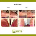 Treat severe Psoriasis and Eczema, steroid free
