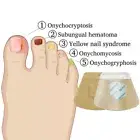 Anti Fungal Nail Treatment Patches Finger Toe Fungus Onychomycosis Repair/s