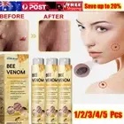 1-5× Tag Recede Bee Venom Treatment Spray Mole Remover Wart Removal For AII Skin