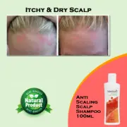 Dry Scalp Psoriasis Shampoo 100ml - Treatment for Dandruff Psoriasis Dry Scalp