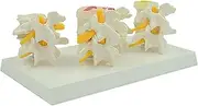 Human Spine Model, 4 Part Pathological Lumbar Spine Model W/informational Card, and Base.Display Herniated Disc, Bone & Disc Degeneration, & Advanced Osteoporosis