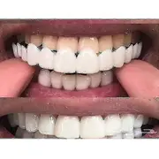 Upper/lower Comfort Fit Flex Whitening Denture Braces Upper lower teeth