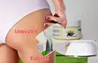 Stretch Marks Removal Cream (NatureProMade). Very Effective Cream!