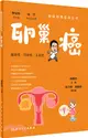 腫瘤科普百科叢書：卵巢癌（簡體書）