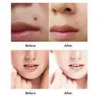 Mole Remover Pen 12 Gears LCD Screen Freckle Removal Skin Spots Beauty Pen With