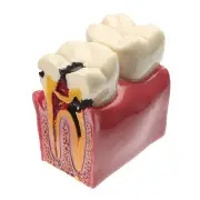 Caries Teeth Comparation Model Dental Study Education Demonstration