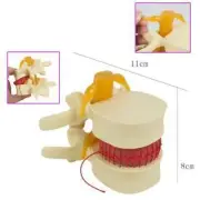 New 1:1.5 Medical Spine Lumbar Disc Herniation Model demonstration Model