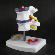 Anatomical Lumbar Disc Herniation Model Human Spine School Training Supplies