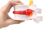 1.5 Times Life Size Lumbar Spine Model for Teaching, Human Anatomical Lumbar Disc Herniation Model, Portable Herniated Lumbar Vertebrae Disc