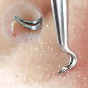 Blackhead Whitehead Pimple Popper Remover Tool Spot Acne Comedone Extractor Zit