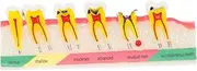 JUMPLAWN Model Portable Tooth Decay Teaching Tool for Oral Education for Dentists and Students and Lightweight Design for Classroom Use