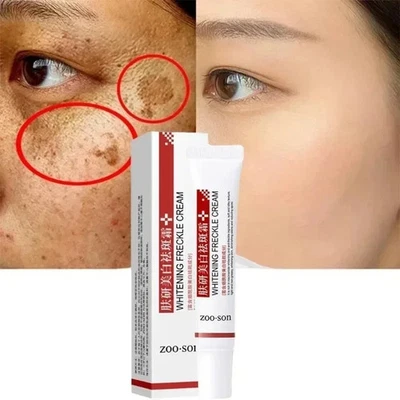 Whitening Freckle Cream for Dark Spots, Melasma & Pigmentation, 20g