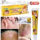 Health Care Psoriasis Cream Eczema Ointment Scalp Psoriasis Hand Tinea Foot 20g