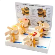VERTEBRAE DEGENERATION MODEL 4 STAGE DISC DEGENERATION SPINE MODEL