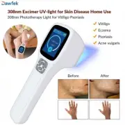 308nm UVB Light Therapy Various Skin Diseases for Hand Leg Arm Eczema
