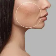 Bespoke Laser Treatment for Acne & Scar Removal in Sydney