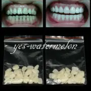 10 Pack Oral Dental Temporary Back Molar Teeth Crown Patch Restoring Teeth New