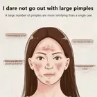 Large Size Acne Pimple Patch Face Treatment Invisible Tools Acne Remover Ble _SE