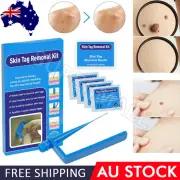 Skin Tag Remover Kit for Fast & Effective Skin Tag Removal OZ