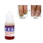 1PC Essence Oil Nail Fungus Killer Toe Fungus Treatment-Onychomycosis Removal-