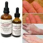 Eczema & Psoriasis Fighter Hair/Body Oil