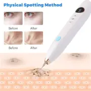 Mole RemoverSkin Tag Remover Device Kit Quick Effective Mole Skin Tags Removal