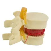1.5x PVC Spine Model for Lumbar Disc Herniation Medical Education Demonstration
