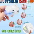 Painless Fingernail Cure Machine Mini Nail Fungus Laser Treatment Therapy Device
