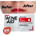 2box Acne-Aid Soap Bar 100g Stiefel Pimple Prone Oily Acne Skin Cleansing Pimple
