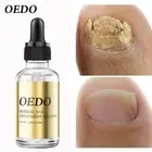 Tratamiento Aceite Esencial A Blanquear Manos Y Pies Herbal Para Uñas Con Hongos