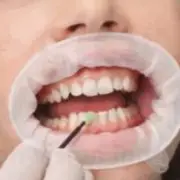 100 Pcs Dental Mouth Opener Disposable Rubber Dam Sterile Cheek Retractor