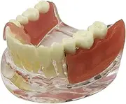 Dental Implant and Restoration Comparison Teeth Model with Removable Gum and Denture for Study Teaching Demo