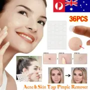 72Pcs Dermopatchy Acne Skin Tag Pimple Remover Patch Removal Facial Care Spot