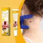 Bee Venom Skin Tag Removal Tr eatment