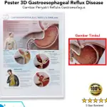 海報 GASTROESOPHAGEAL 回流疾病 BS 317 圖片壓紋海報