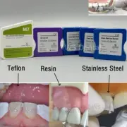 Dental Teflon/Resin/Metal Matrix Bands Teeth Restoration Matrix Strips Retainer
