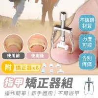 在飛比找蝦皮購物優惠-【指甲矯正器】七件組 嵌甲 凍甲 卷甲 矯正器 甲溝炎 指甲