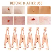 warts skin tag remover clip 12pcs warts remove flesh moles with warts