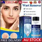 30ML Skin Tag Removal Kit At-home Skin Tag Remover Fast Acting Wart Freeze Off
