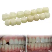 Dental Oral Temporary Anterior Teeth Crown Caps Tooth Synthetic Resin 120 Pcs
