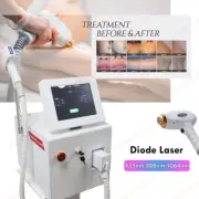 NEW Diode Laser 755nm/808nm/1064nm Permanent Body Hair Removal Pigment Machine