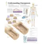 UNDERSTANDING OSTEOPOROSIS PAPER CHART