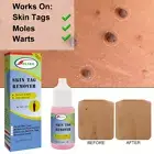 Skin Tag Remover Kit Removing Liquid Removal Moles Warts Natural Treatment 10ml