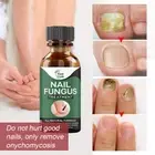 10/50ml Strength Toenail Fungus Anti Infection Painless (50ml) Hot