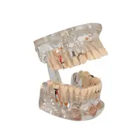 Pro Dental Study Education Teach Implant Teeth Model Restoration Bridge Medical Model