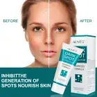 Face Tone Whitening Cream Dark Spot Remover Skin Corrector Freckle Mole Removal