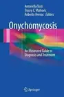 Onychomycosis: An Illustrated Guide to Diagnosis and Treatment by Antonella Tost
