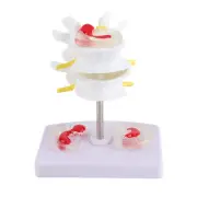 Anatomical Lumbar Disc Herniation Demonstration Model Human Spine School Tra DSO