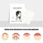 24/36/48/72X Acne Pimple Patches Invisible Acne Treatment Waterproof Mask Z8I9